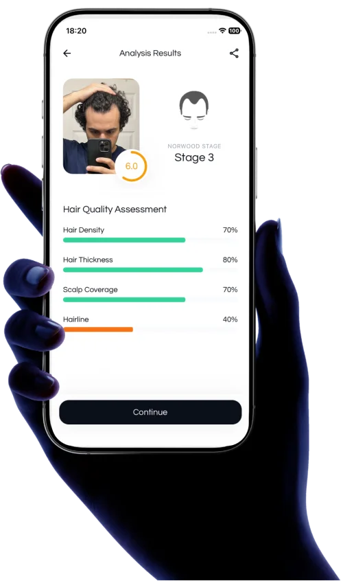 Hairloss Tracker App showing AI-powered density and thickness scores